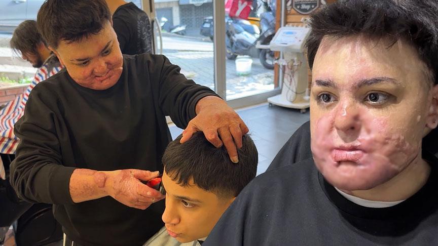 Hayatı birkaç saniye içinde kabusa döndü!15 yaşında 8 ayda 65 ameliyat geçirdi: 'Babamdan özür diledim'