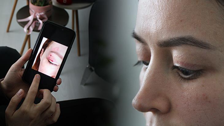 Bin 100 liraya yaptırdı, 150 bin liraya düzeltilemiyor! Güzellik merkezi kabusu: Bunu acı bir şekilde öğrenmiş oldum