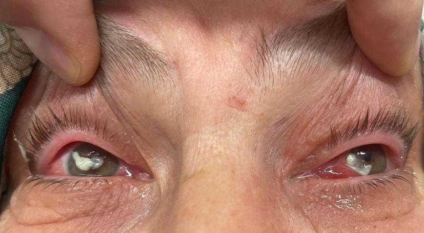 Kızının önerisiyle gözüne damlattı hayatı karardı! ‘Sosyal medyada çok yaygınlaşmaya başladı’